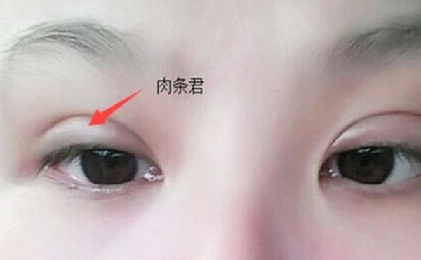 雙眼皮不自然怎么補(bǔ)救？雙眼皮肉條好修復(fù)么？
