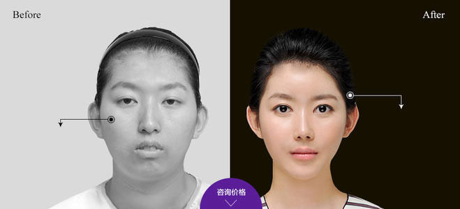 下頜角整形的方法有哪些？