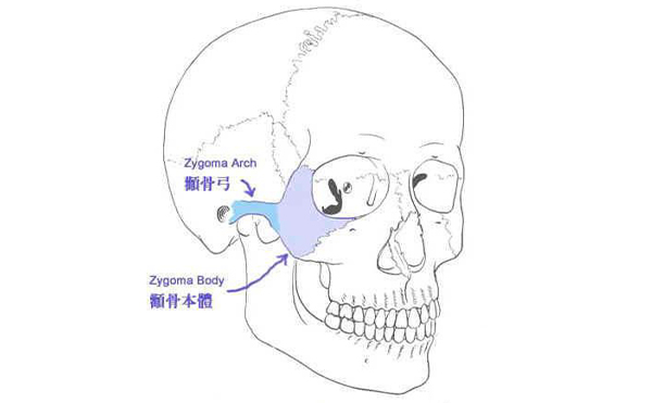 什么樣的臉型需要做顴骨整形？