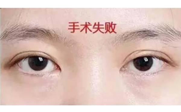 韓式三點雙眼皮的優(yōu)點是什么?術后怎么避免不對稱?