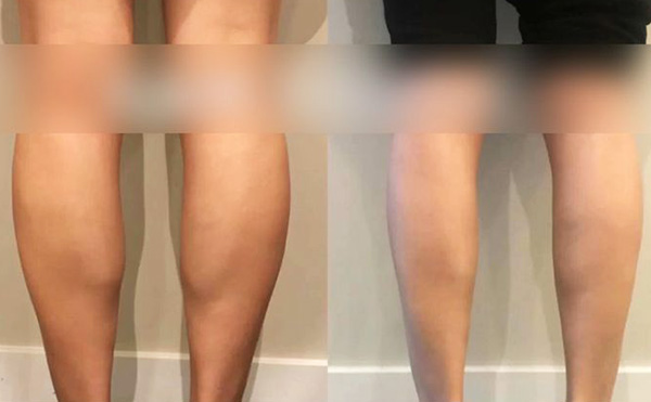 打瘦腿針是怎么操作的？
