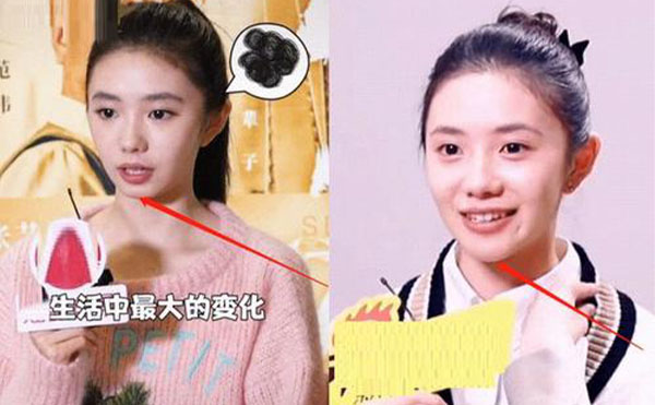 玻尿酸隆下巴整形攻略【優(yōu)勢、適宜人群、注意事項(xiàng)】
