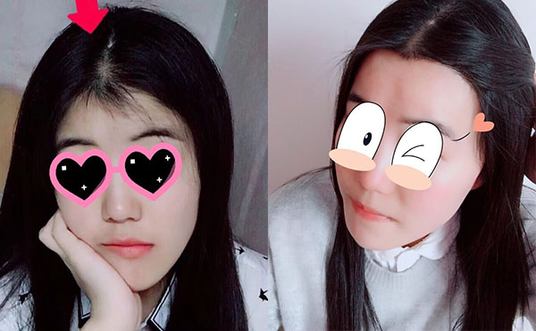 冰點(diǎn)脫毛發(fā)際線怎么樣？