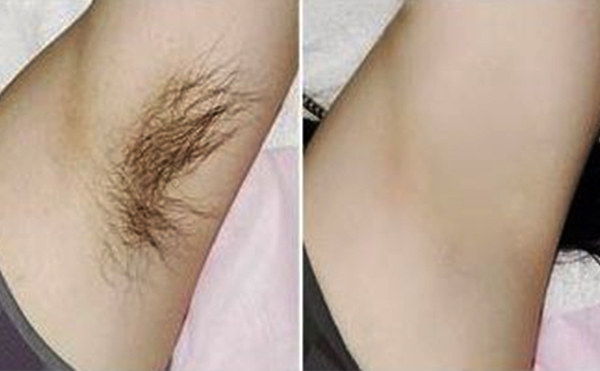 光子脫腋毛有什么優(yōu)勢(shì)？