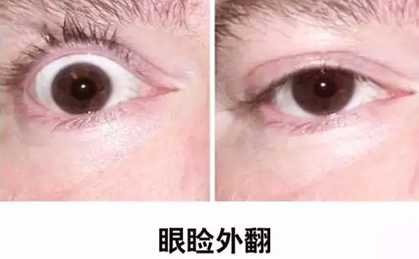 醫(yī)美技術(shù)越來越發(fā)達，不少愛美的人本著變美的心情滿懷期待地去做雙眼皮、開眼角等項目，不料整容不成、反倒毀容，后悔也來不及。有些做雙眼皮的姑娘術(shù)后出現(xiàn)眼瞼外翻的情況，那眼瞼外翻是什么意思?上眼瞼外翻如何修復(fù)?