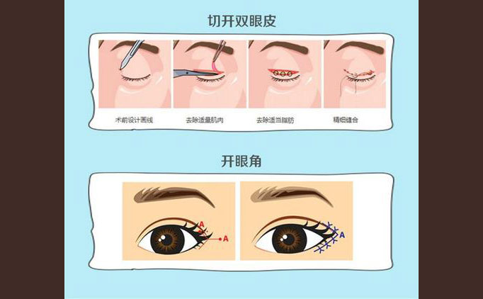 眼部修復(fù)手術(shù)包括什么項目？
