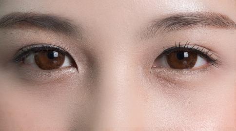 上眼皮松弛是什么原因引起的？
