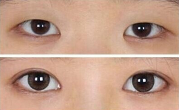 眼球突出矯正術(shù)恢復(fù)時間需要多久?術(shù)后怎么護(hù)理?
