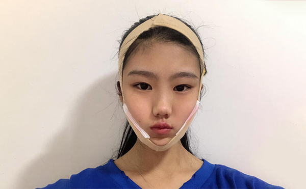 想要確保下頜角整形手術順利和術后效果，術前應該做哪些攻略?