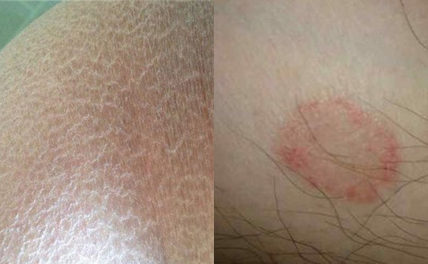 脫腋毛有什么副作用嗎？