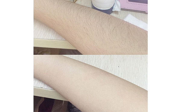 光子手臂脫毛效果怎么樣？