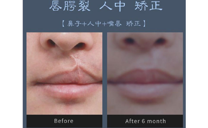 唇裂修復(fù)術(shù)需要多少錢？