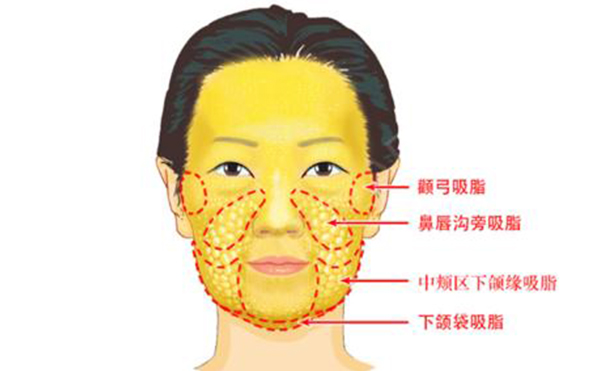 面部吸脂有哪些部位？