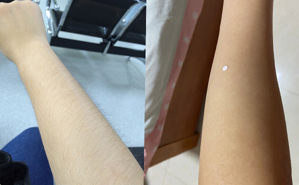 激光手臂脫毛價(jià)格貴不貴？