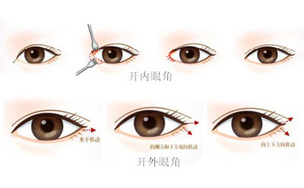 開(kāi)內(nèi)眼角和外眼角有什么區(qū)別?開(kāi)內(nèi)眼角需要注意什么?
