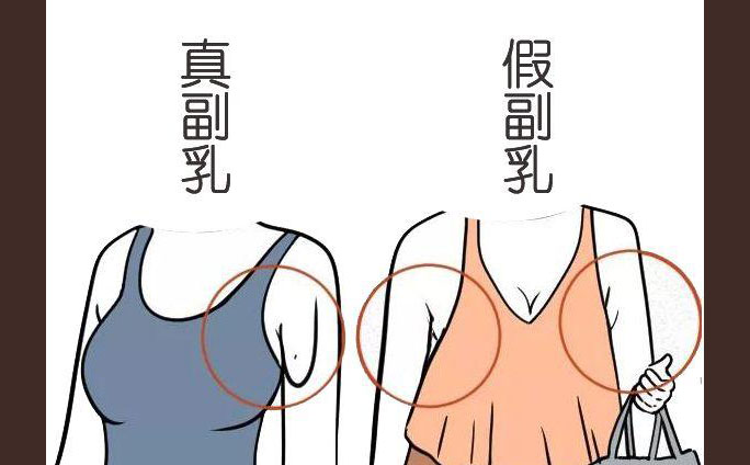 多乳癥是什么癥狀？