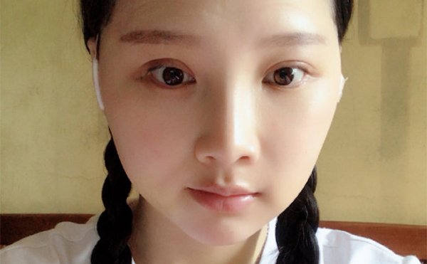 北京聯(lián)合麗格下頜角整形案例術后一周