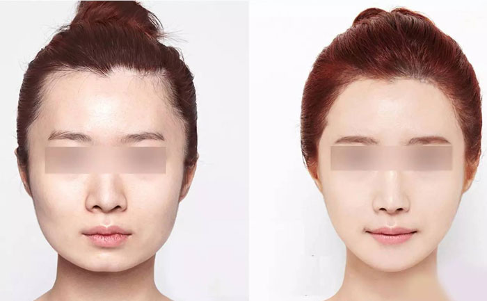 臉部咬肌肥大怎么瘦？臉部咬肌肥大如何去除？
