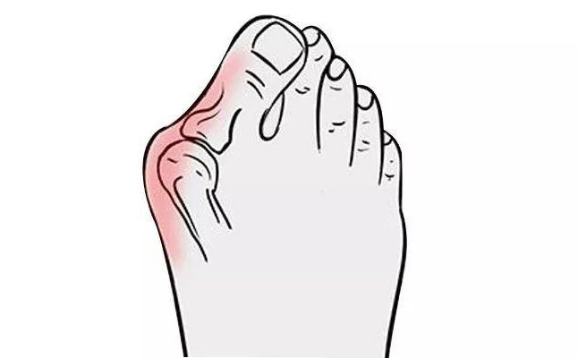 大腳骨矯正手術(shù)多少錢？大腳骨矯正三個月可以恢復(fù)嗎？