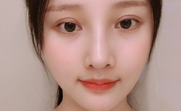 北京聯(lián)合麗格下頜角整形案例術后兩個月