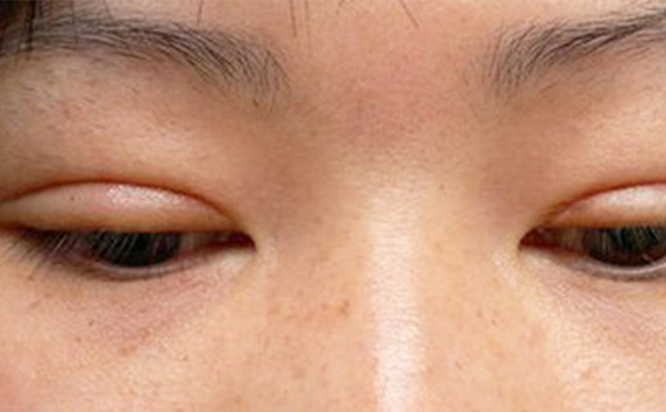 埋線雙眼皮失敗該如何修復(fù)？多久修復(fù)好？