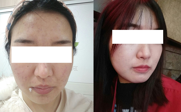 美白針可以維持多久？