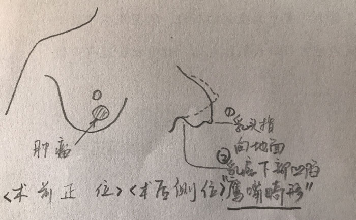 乳房畸形是什么原因造成的？乳房畸形矯正手術(shù)方法？