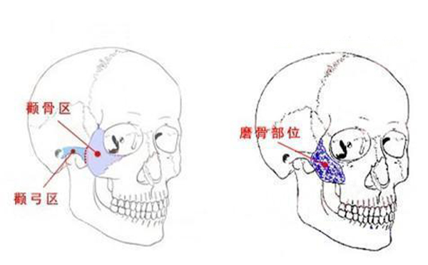 顴骨整形一般是從哪里切口？
