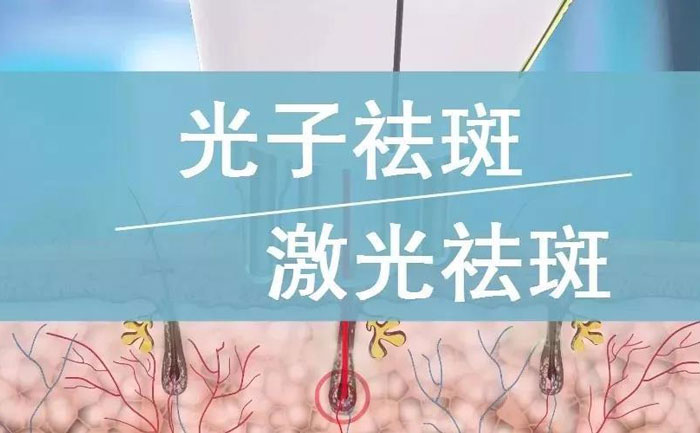 光子祛斑效果如何？