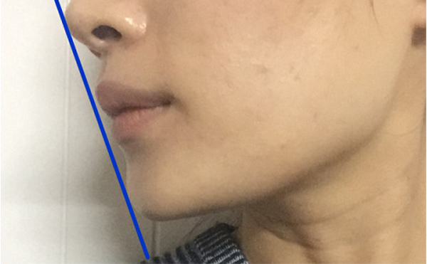 做假體墊下巴恢復(fù)后會(huì)被摸出來做過嗎？還能打玻尿酸嗎？