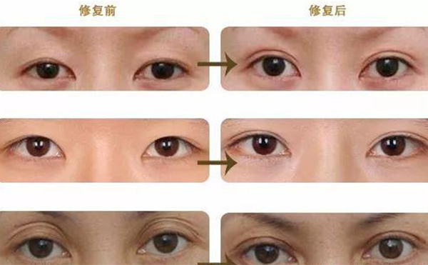 雙眼皮修復(fù)可靠嗎？什么時候做雙眼皮修復(fù)比較好？
