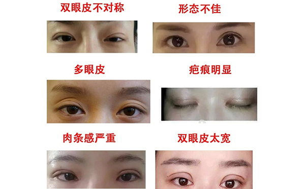 哪些情況需做雙眼皮修復？修復難度大不大?