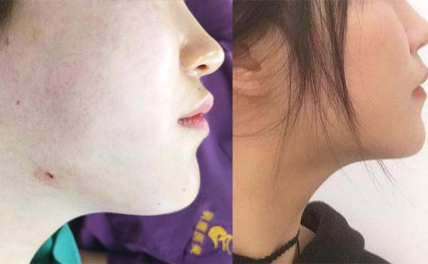 面部吸脂恢復(fù)期多長(zhǎng)時(shí)間？