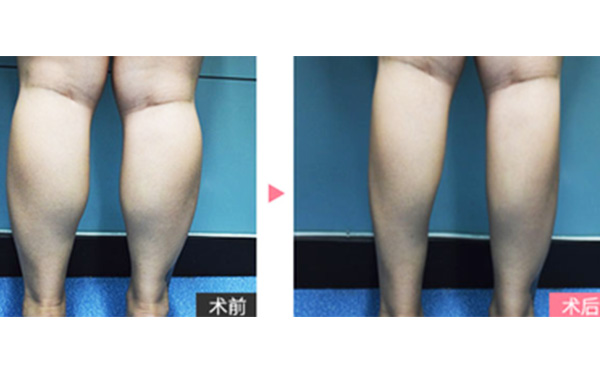 boxo瘦腿有什么優(yōu)勢(shì)？