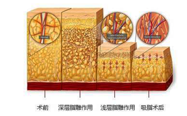 韓式分層吸脂的效果怎么樣？