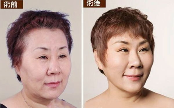 拉皮手術(shù)多久能恢復(fù)自然？