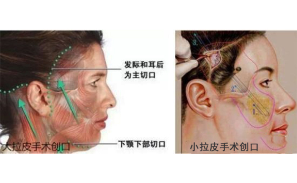 小拉皮和傳統(tǒng)拉皮有什么區(qū)別？