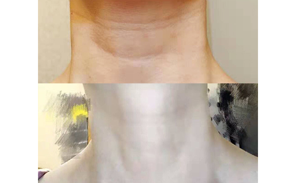 嗨體可以長期使用嗎？