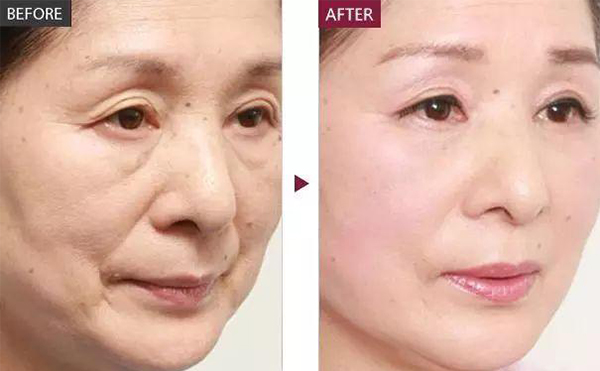 膠原蛋白除皺的適應人群？