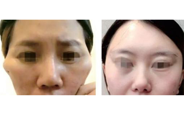 筋膜懸吊除皺有什么副作用？