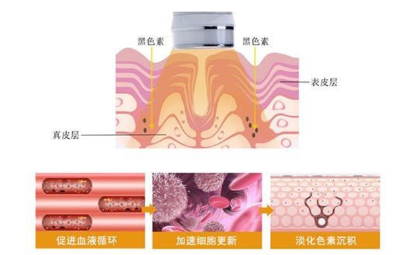 光子嫩膚效果好不好？
