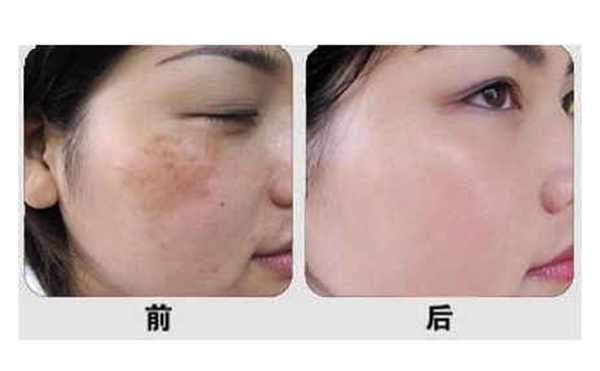 光子嫩膚有什么優(yōu)勢？