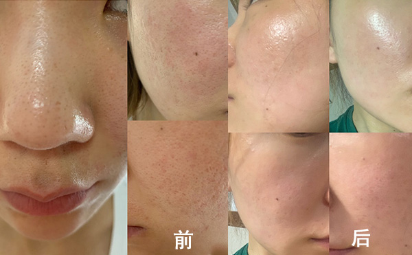 無針水光有什么優(yōu)勢？