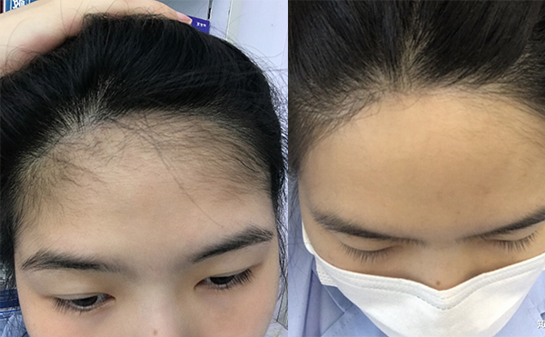 激光脫發(fā)際線的過程是什么？