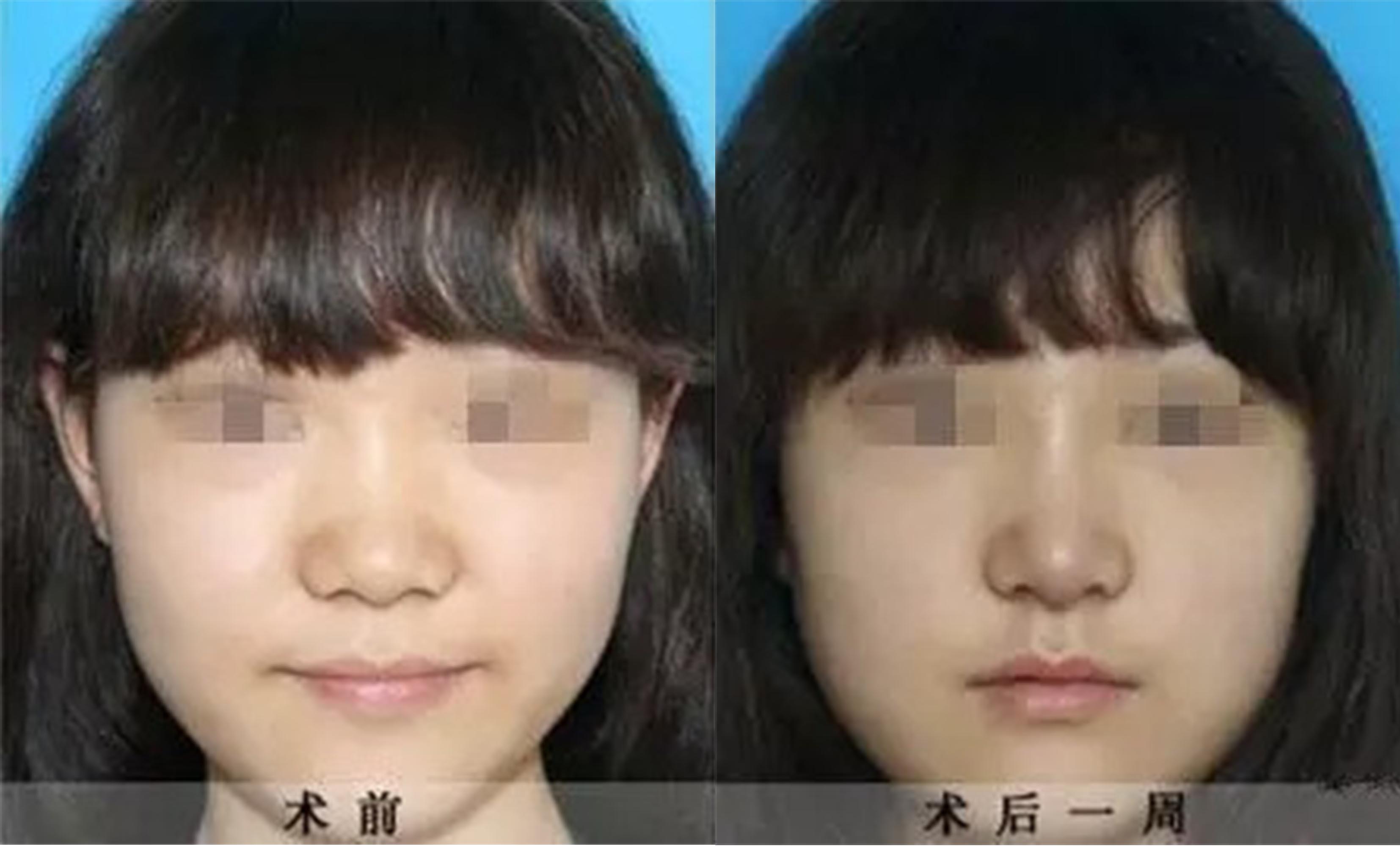 鼻頭、鼻翼縮小