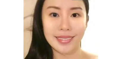 三文魚針術后
