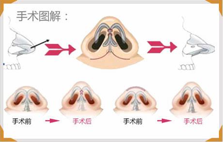 縮鼻頭手術(shù)可以保持多久？縮鼻頭手術(shù)術(shù)后注意事項(xiàng)？