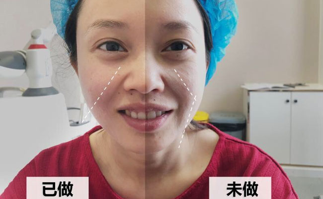 激光溶脂瘦臉的副作用及效果？光纖溶脂瘦臉多久可以見效？