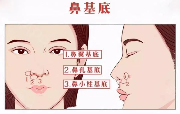 自體脂肪填充鼻基底好不好？鼻基底脂肪填充多久恢復(fù)？