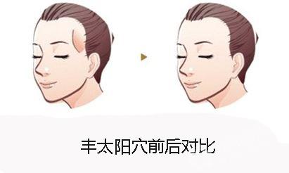什么是自體脂肪豐太陽穴？用自體脂肪豐太陽穴的效果能維持多久？